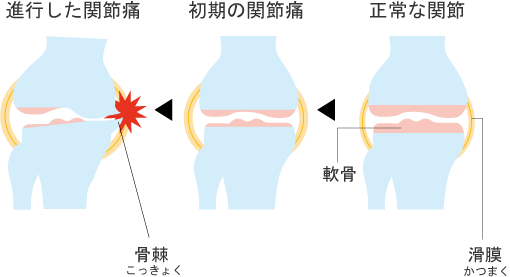 関節痛の進行図　