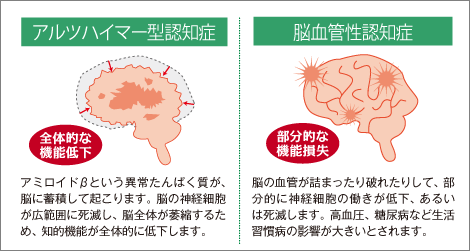 ルツハイマー型と脳血管性認知症