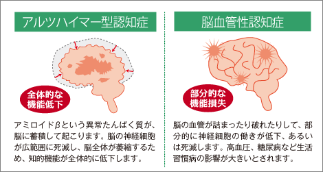 症 血管 性 認知