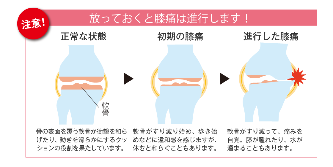 放っておくと膝痛は進行します！