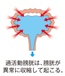 過活動膀胱