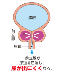 尿漏れの原因